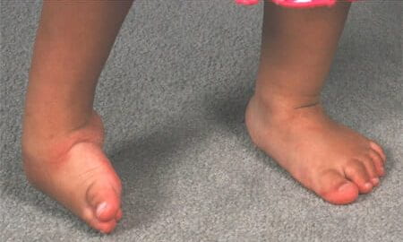 Child with musculoskeletal disorder - feet